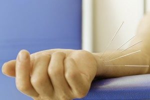 acupuncture-carpal-tunnel-syndrome-wrist-300x200